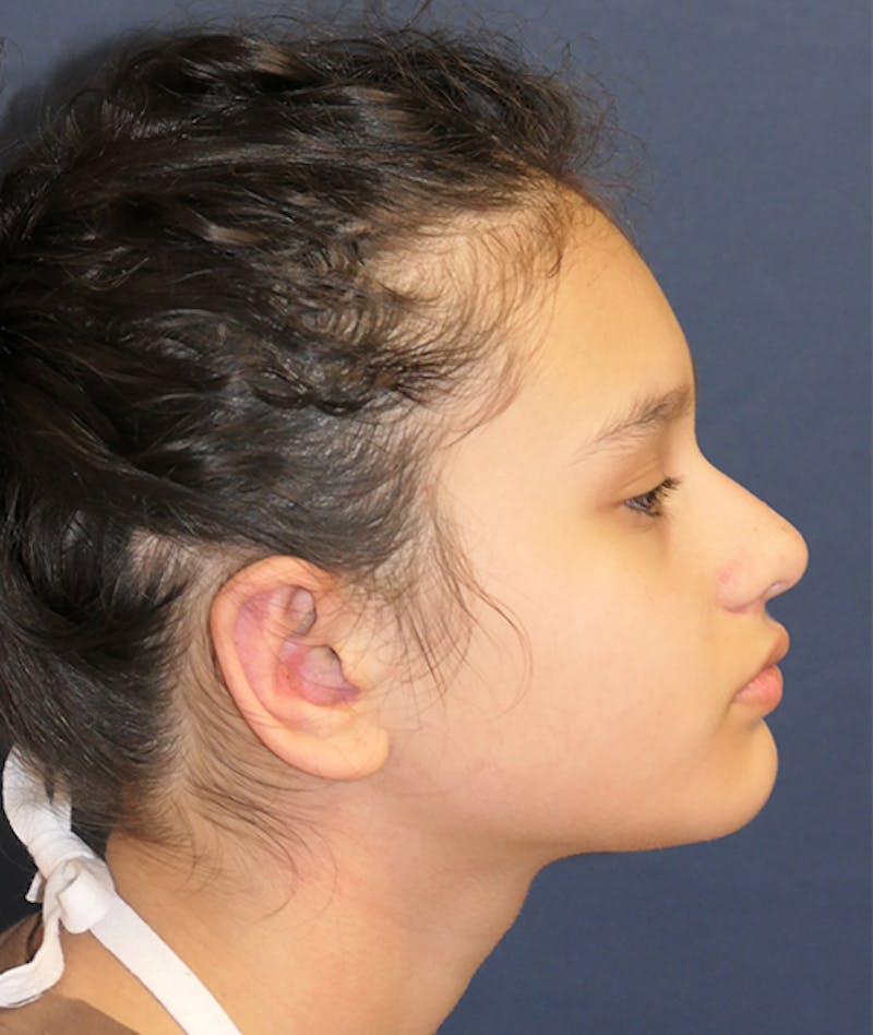 Otoplasty Before & After Gallery - Patient 423983 - Image 6