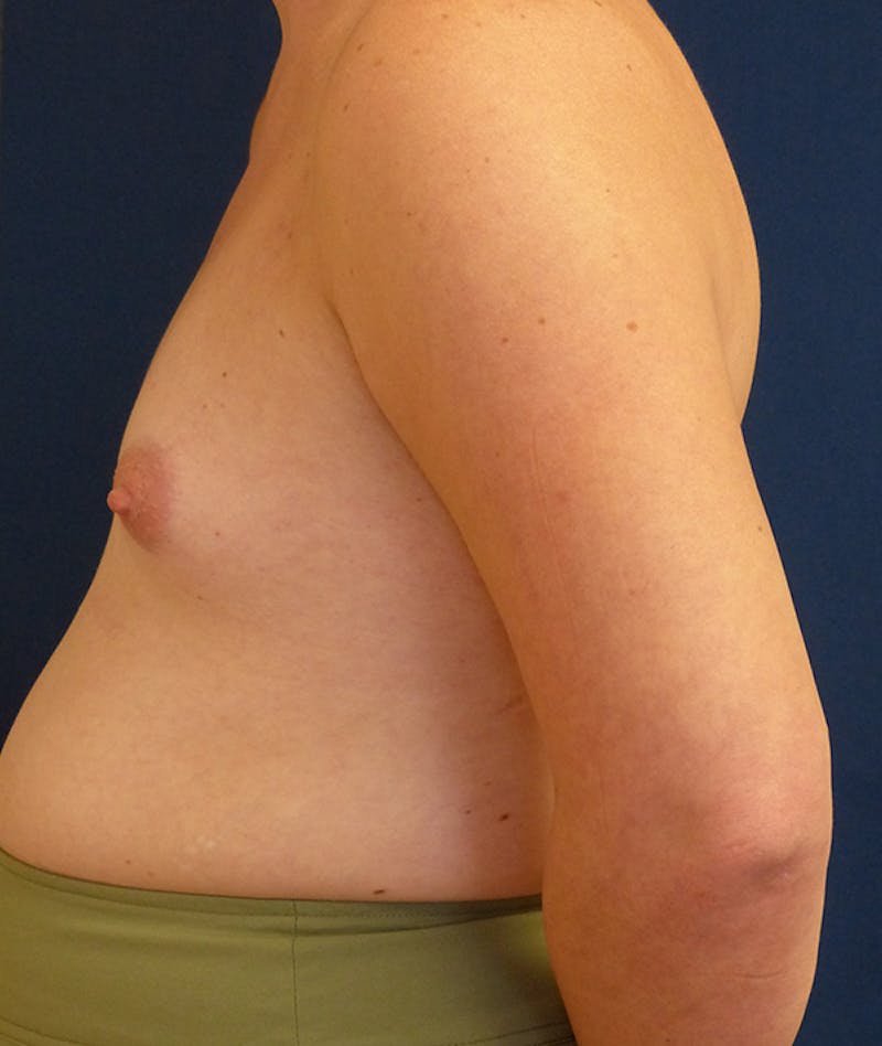 Feminizing Surgery Before & After Gallery - Patient 362358 - Image 9