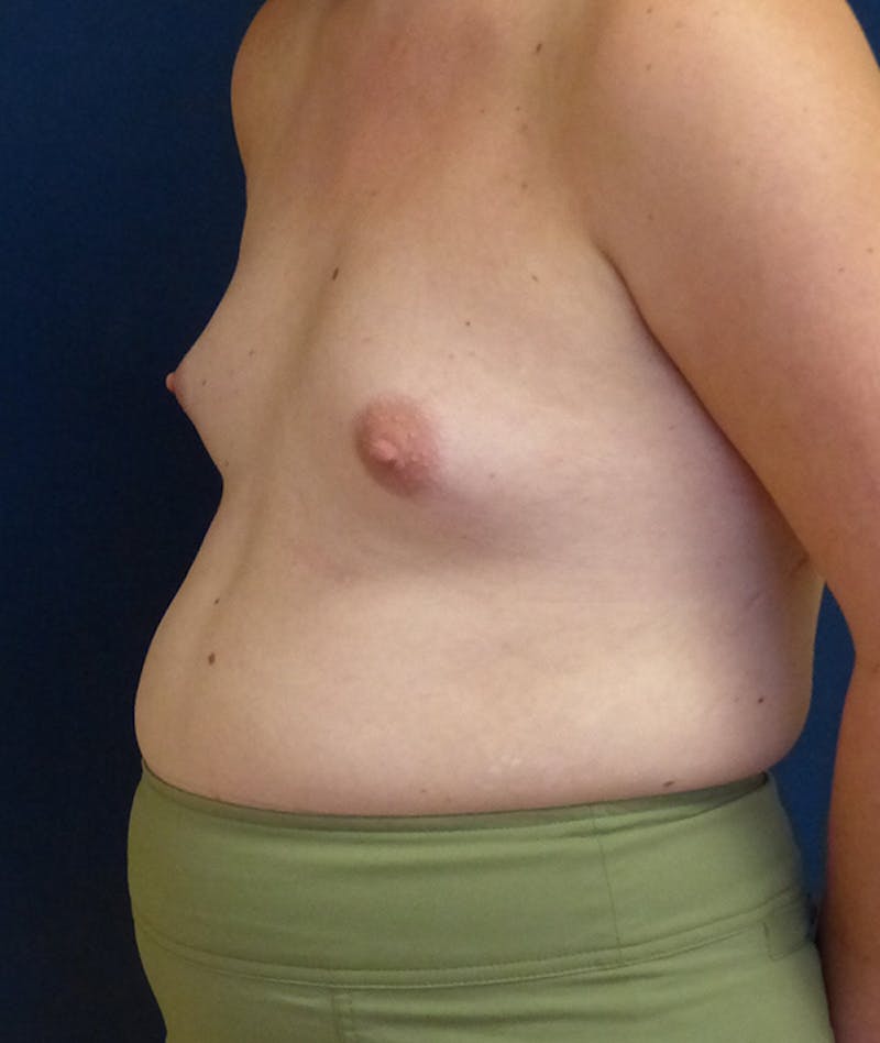Feminizing Surgery Before & After Gallery - Patient 362358 - Image 7