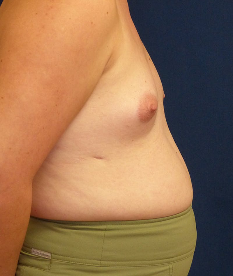 Feminizing Surgery Before & After Gallery - Patient 362358 - Image 5
