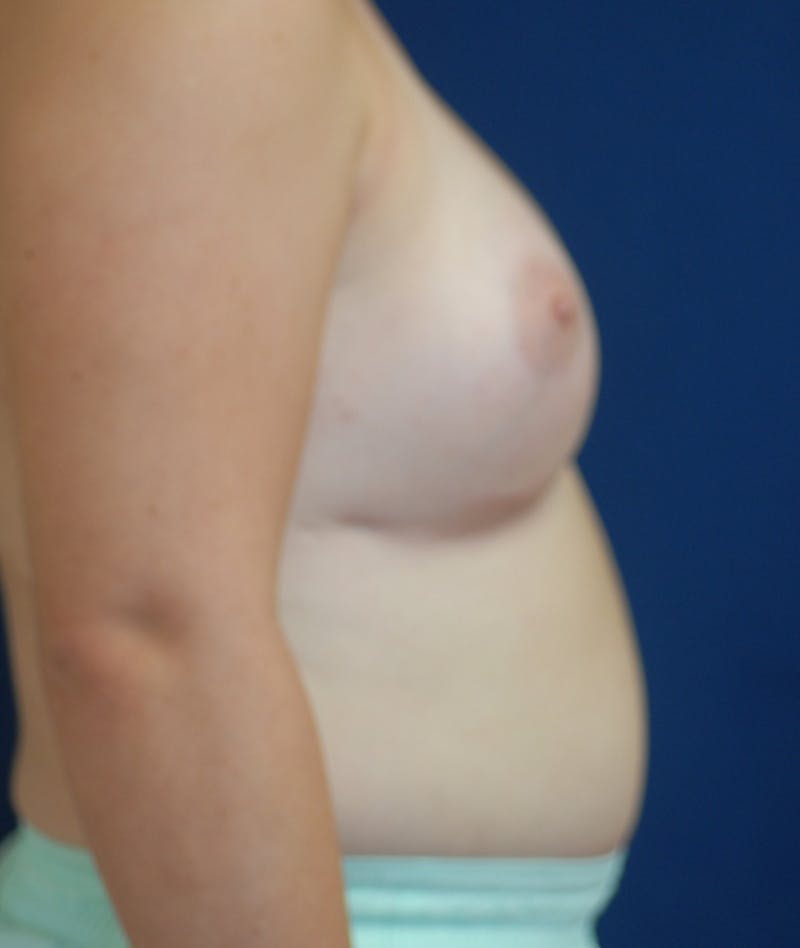 Feminizing Surgery Before & After Gallery - Patient 362358 - Image 6