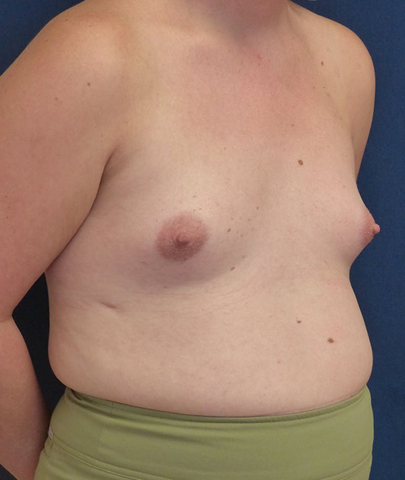 Feminizing Surgery Before & After Gallery - Patient 362358 - Image 3