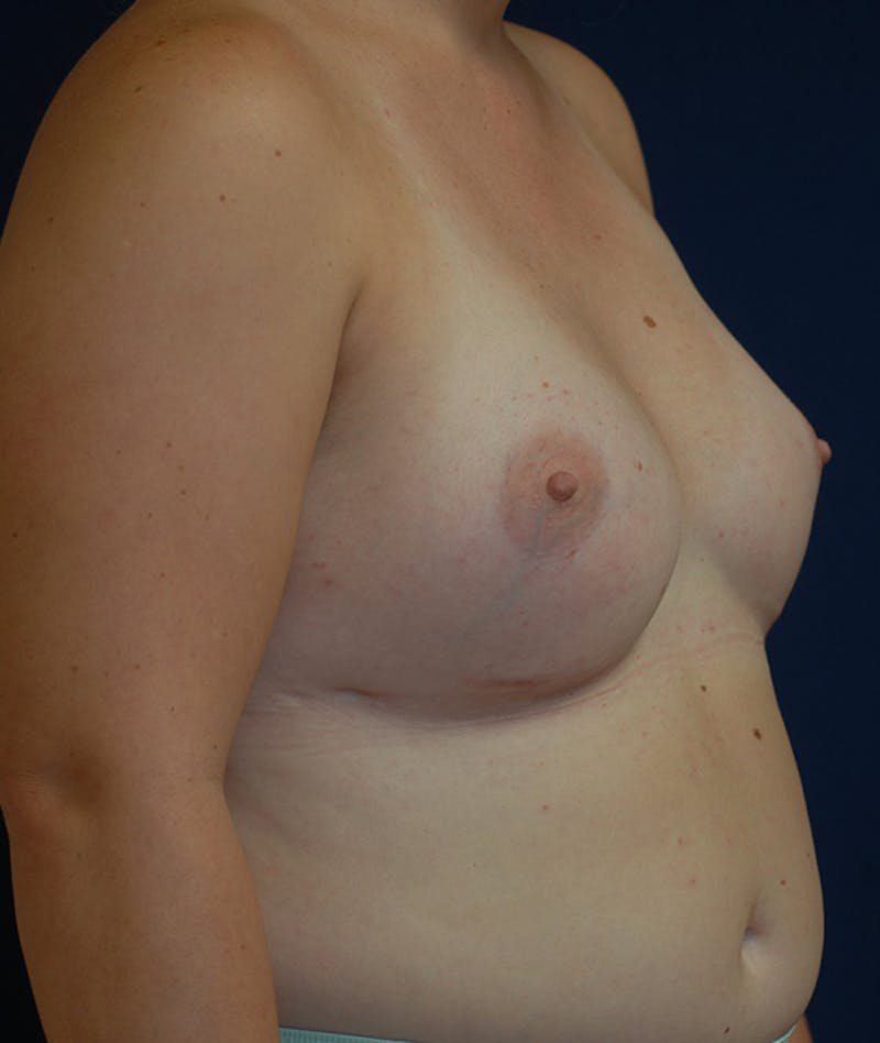 Feminizing Surgery Before & After Gallery - Patient 362358 - Image 4