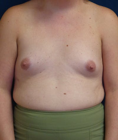 Feminizing Surgery Before & After Gallery - Patient 362358 - Image 1