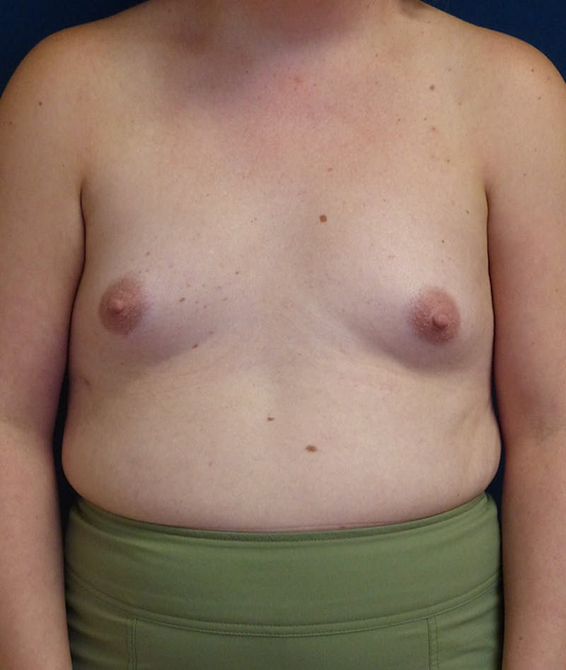 Feminizing Surgery Before & After Gallery - Patient 362358 - Image 1