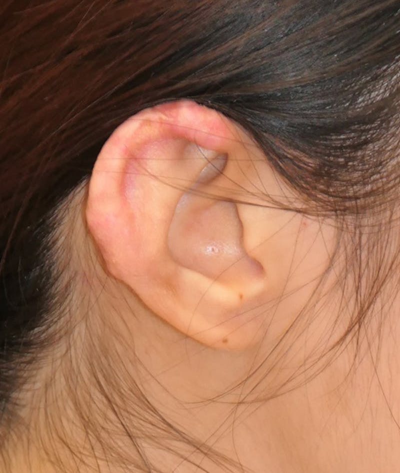 Miscellaneous Before & After Gallery - Patient 110894 - Image 6