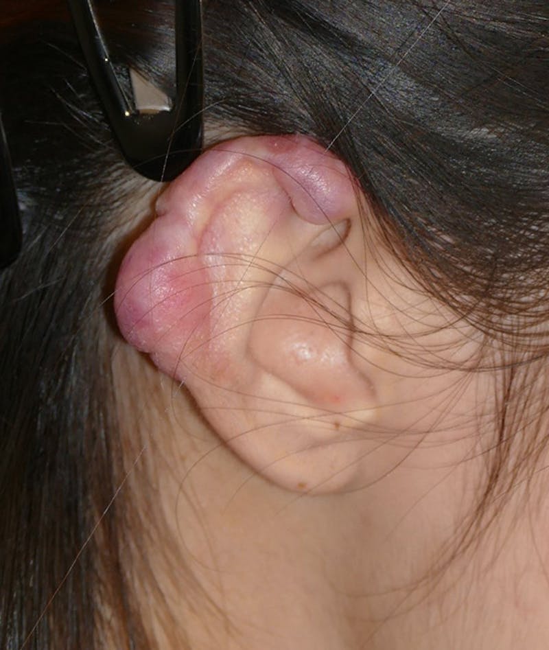 Miscellaneous Before & After Gallery - Patient 110894 - Image 5