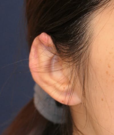 Miscellaneous Before & After Gallery - Patient 110894 - Image 2