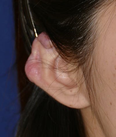 Miscellaneous Before & After Gallery - Patient 110894 - Image 1