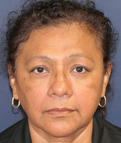 Miscellaneous Before & After Gallery - Patient 475986 - Image 2
