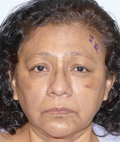 Miscellaneous Before & After Gallery - Patient 475986 - Image 1