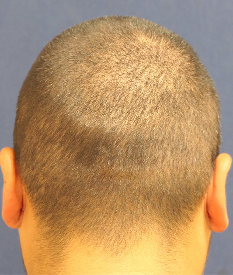 Ear Pinning (Otoplasty) Before & After Gallery - Patient 552641 - Image 8