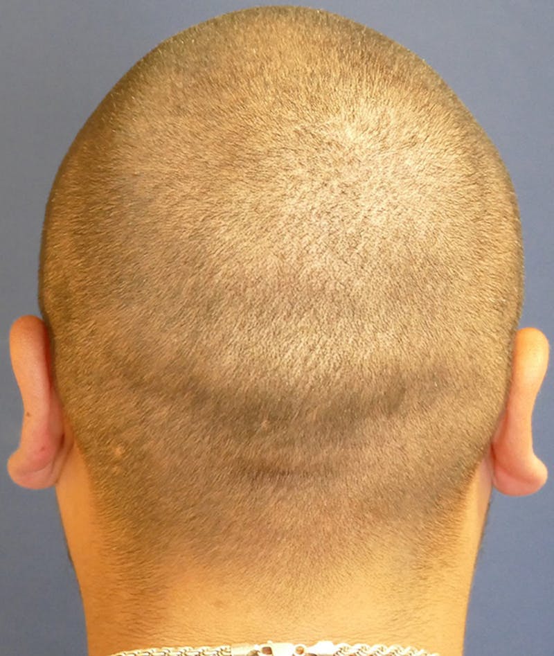 Ear Pinning (Otoplasty) Before & After Gallery - Patient 552641 - Image 7