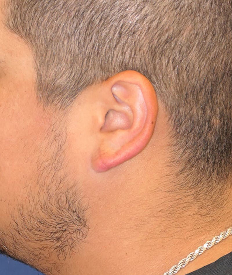 Ear Pinning (Otoplasty) Before & After Gallery - Patient 552641 - Image 6