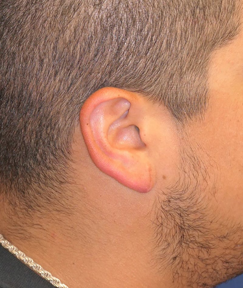 Ear Pinning (Otoplasty) Before & After Gallery - Patient 552641 - Image 4