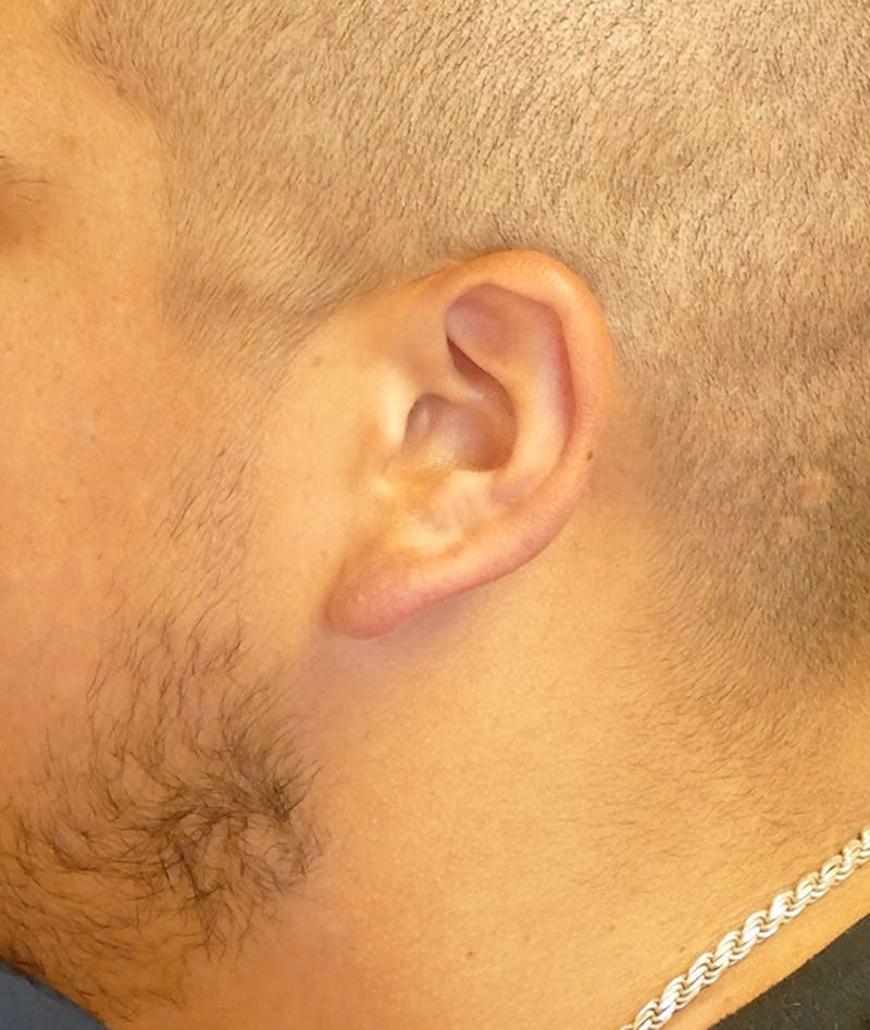 Ear Pinning (Otoplasty) Before & After Gallery - Patient 552641 - Image 5