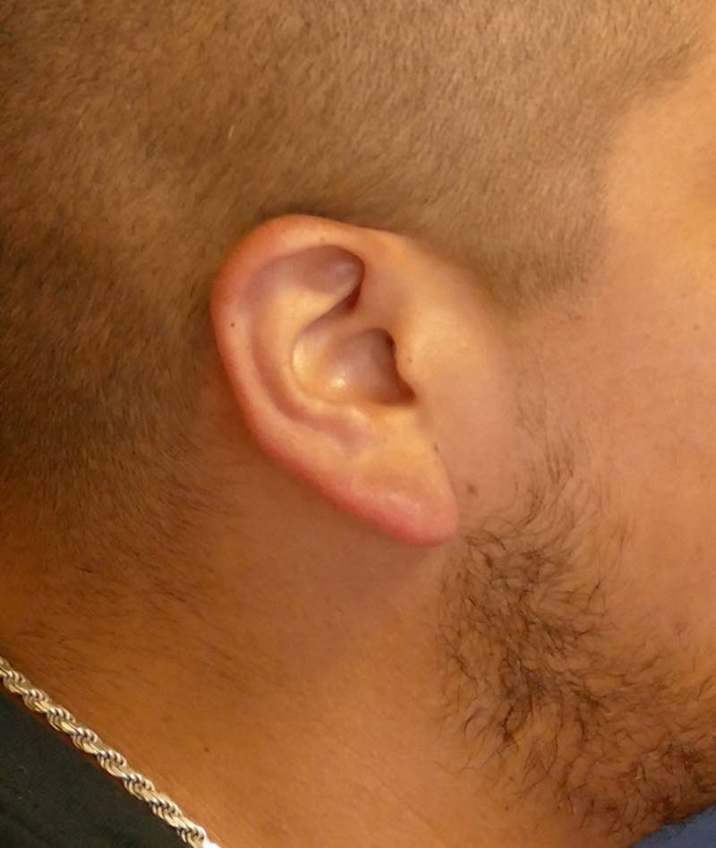 Ear Pinning (Otoplasty) Before & After Gallery - Patient 552641 - Image 3