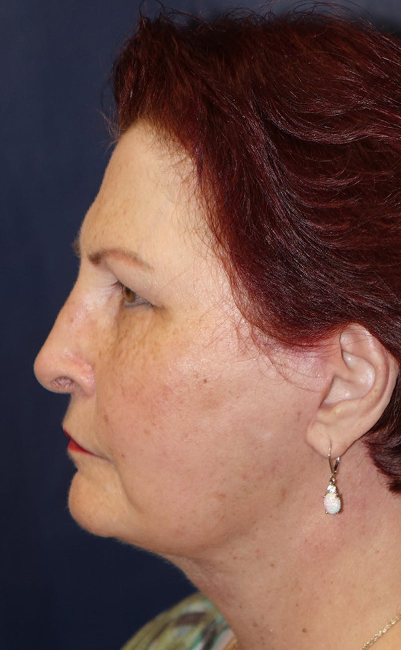 Facelift Before & After Gallery - Patient 321357 - Image 10