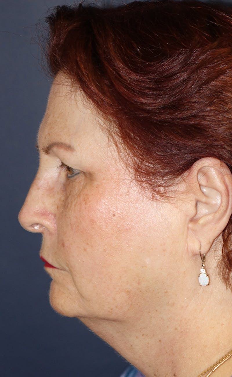 Facelift Before & After Gallery - Patient 321357 - Image 9