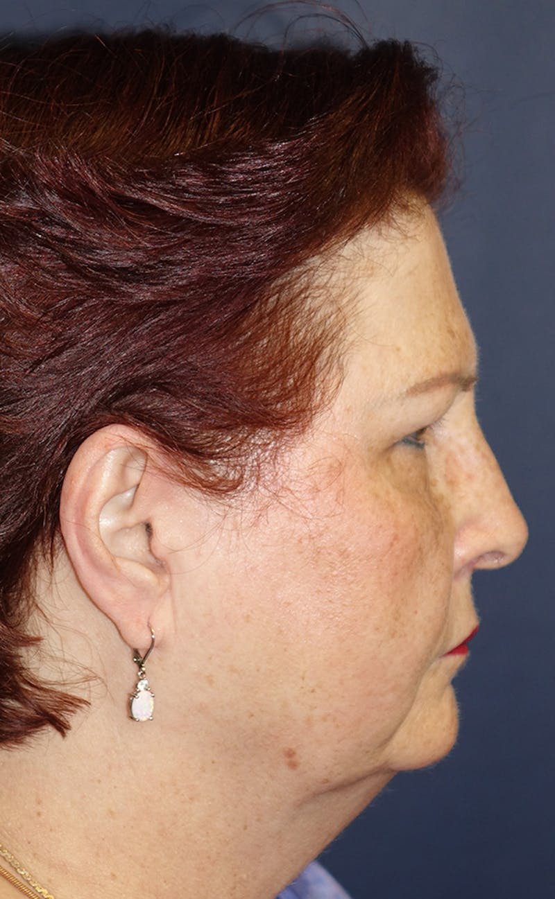 Facelift Before & After Gallery - Patient 321357 - Image 5