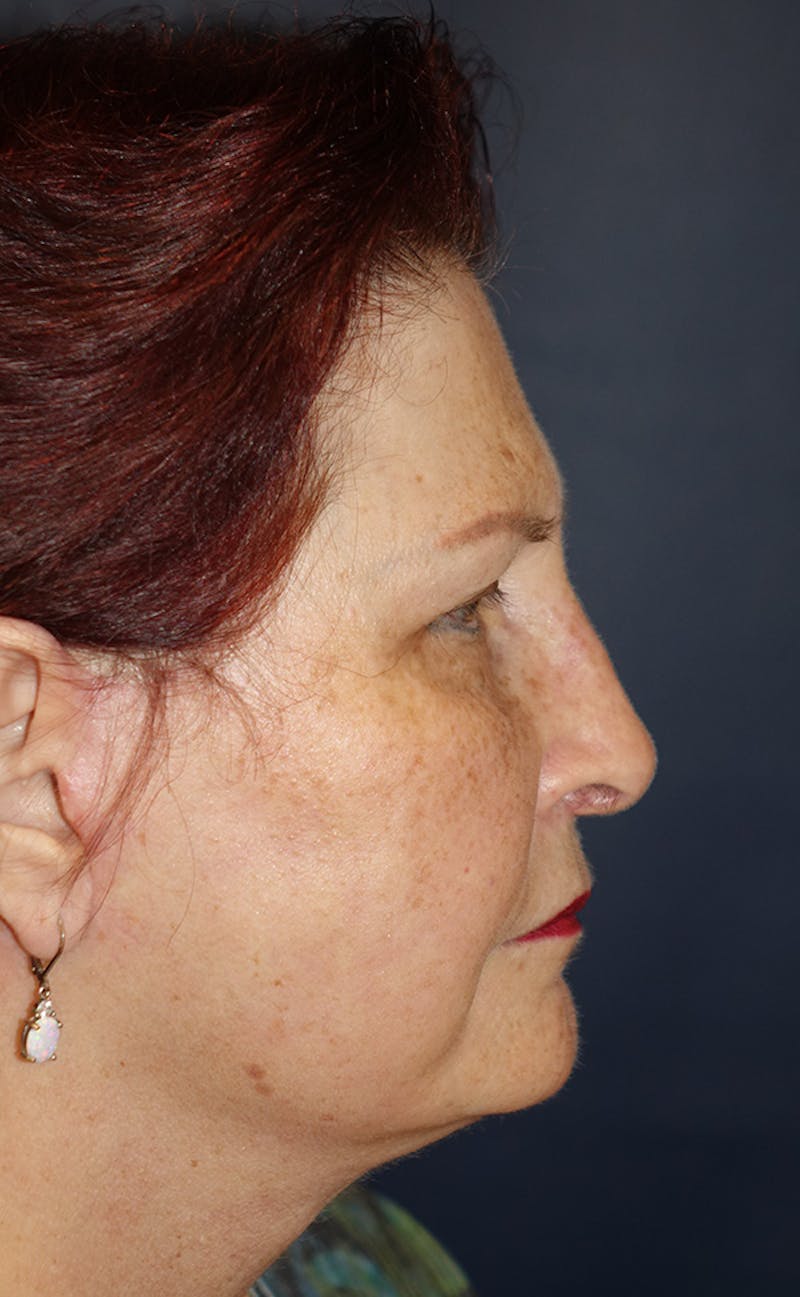 Facelift Before & After Gallery - Patient 321357 - Image 6