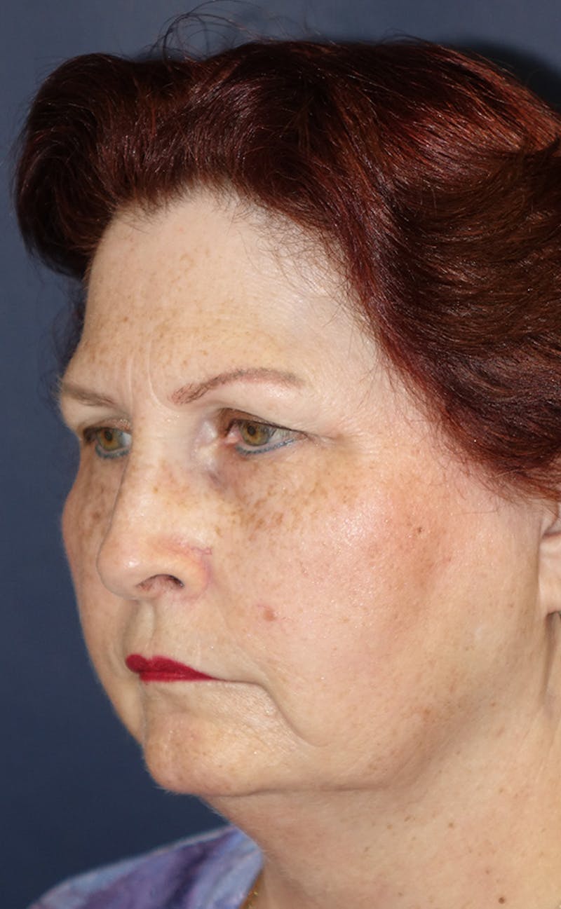Facelift Before & After Gallery - Patient 321357 - Image 7