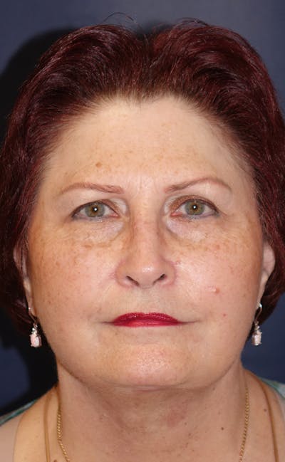 Facelift Before & After Gallery - Patient 321357 - Image 2