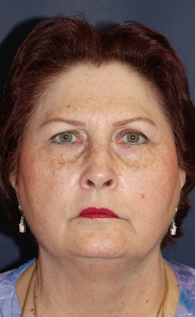 Facelift Before & After Gallery - Patient 321357 - Image 1