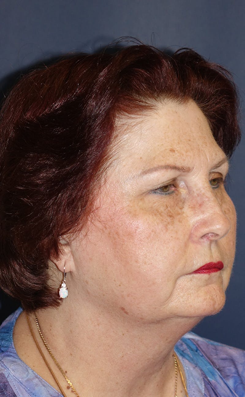 Facelift Before & After Gallery - Patient 321357 - Image 3