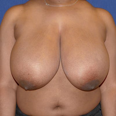 Breast Reduction Before & After Gallery - Patient 144156 - Image 1