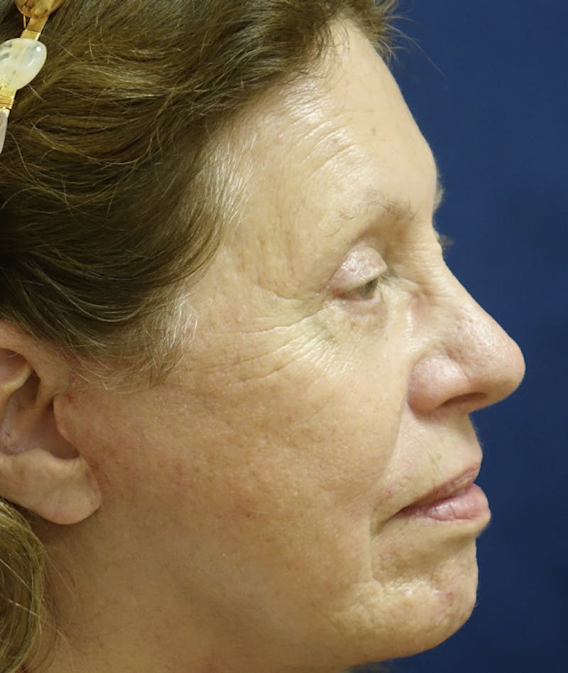 Eyelid Lift (Blepharoplasty) Before & After Gallery - Patient 167907 - Image 6