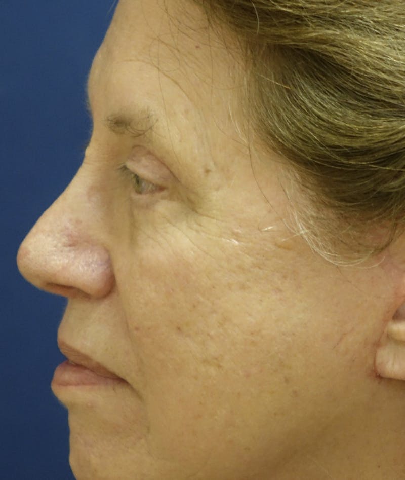 Eyelid Lift (Blepharoplasty) Before & After Gallery - Patient 167907 - Image 4
