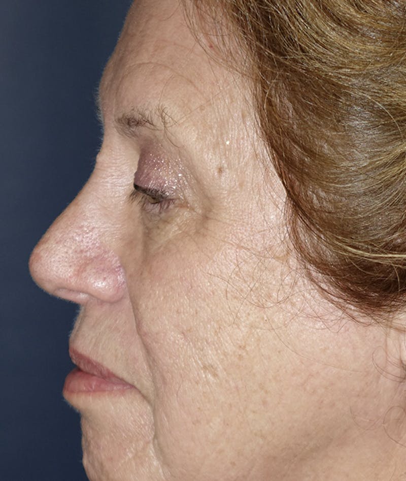 Eyelid Lift (Blepharoplasty) Before & After Gallery - Patient 167907 - Image 3