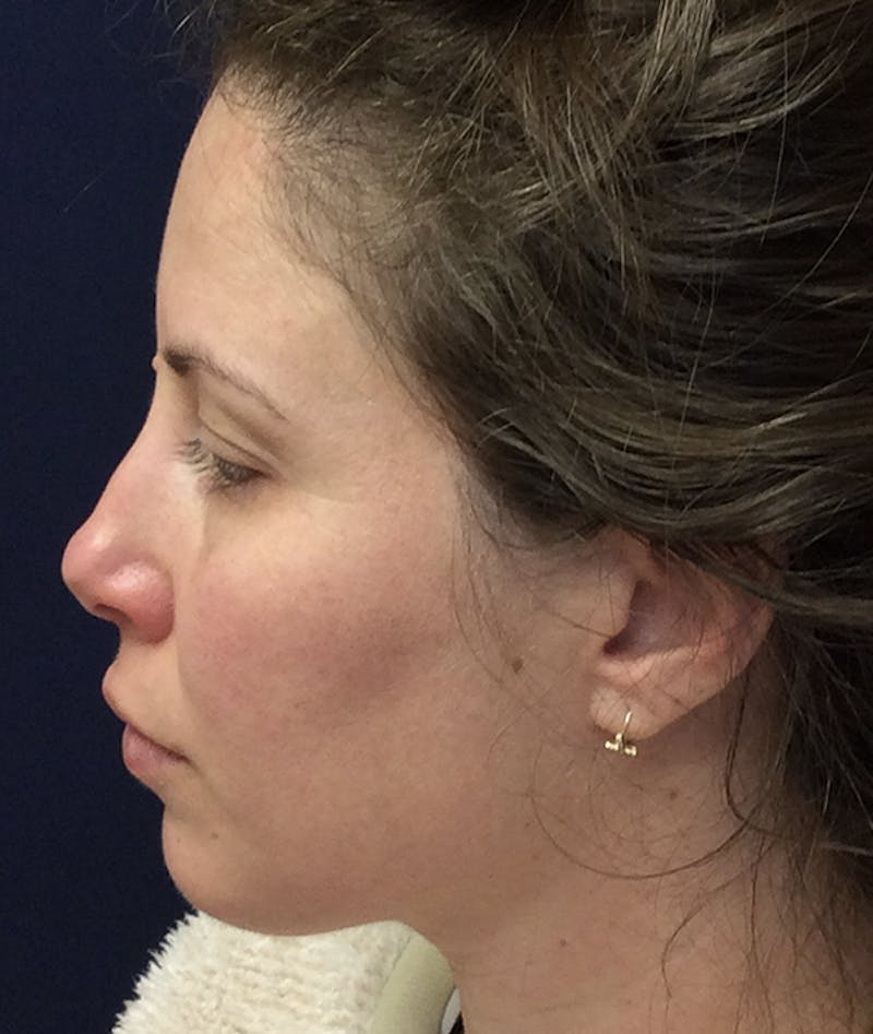 Rhinoplasty Before & After Gallery - Patient 939005 - Image 7