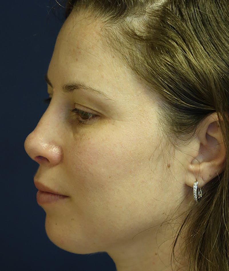 Rhinoplasty Before & After Gallery - Patient 939005 - Image 8