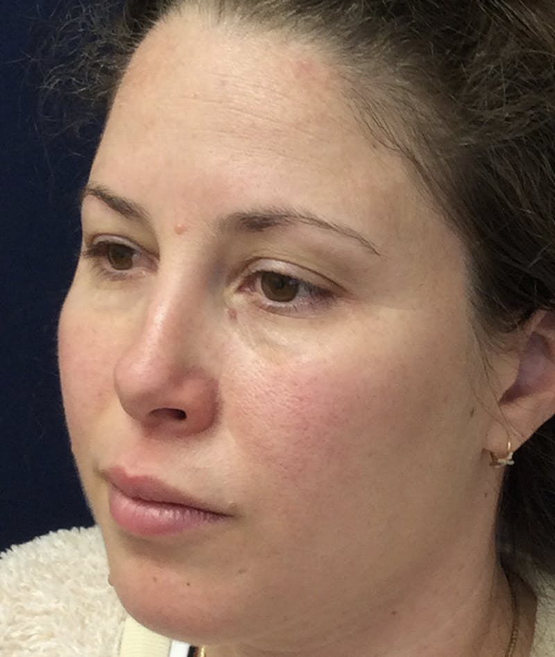 Rhinoplasty Before & After Gallery - Patient 939005 - Image 5