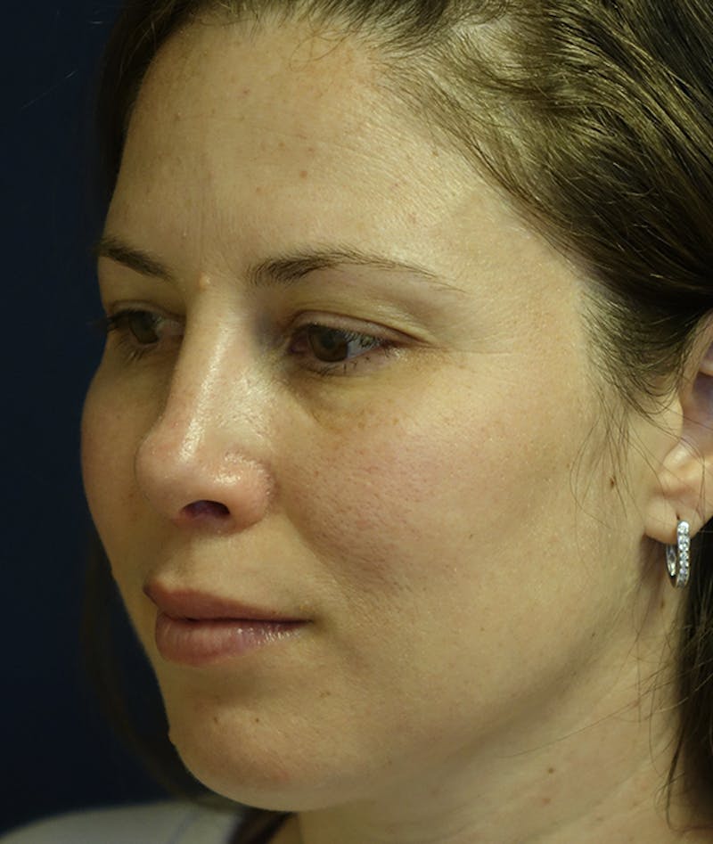 Rhinoplasty Before & After Gallery - Patient 939005 - Image 6