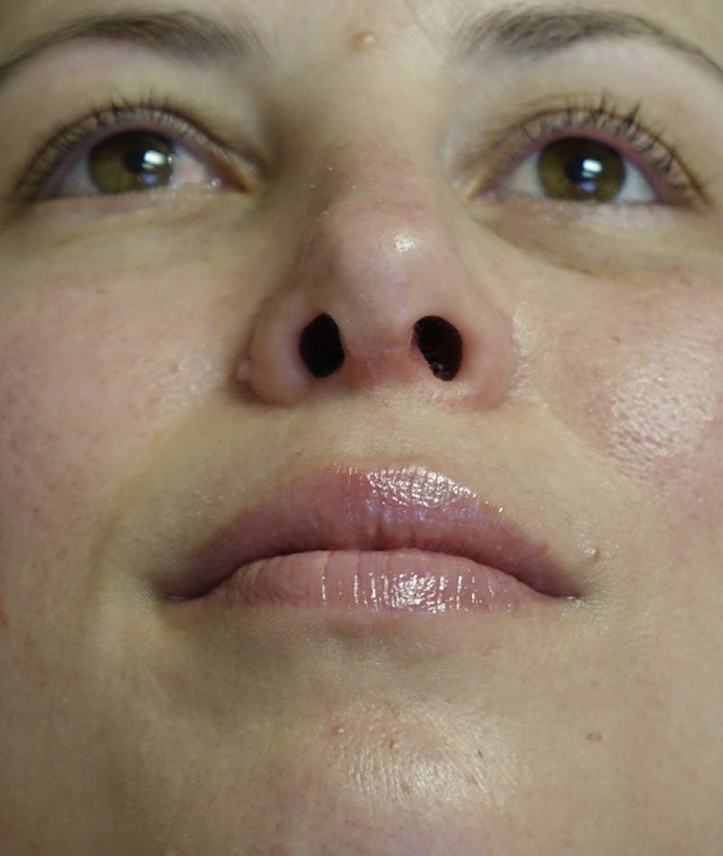 Rhinoplasty Before & After Gallery - Patient 939005 - Image 4