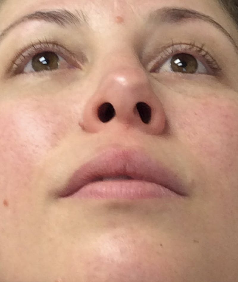 Rhinoplasty Before & After Gallery - Patient 939005 - Image 3
