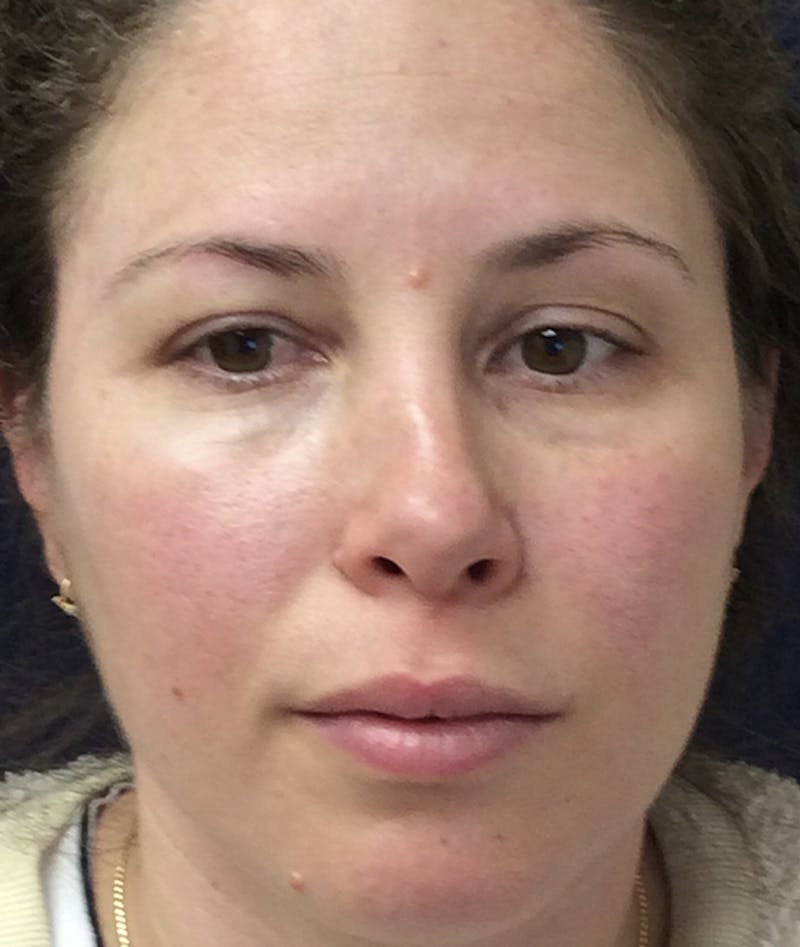 Rhinoplasty Before & After Gallery - Patient 939005 - Image 1