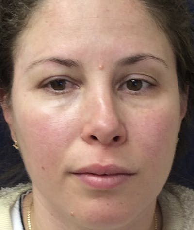 Rhinoplasty Before & After Gallery - Patient 939005 - Image 1