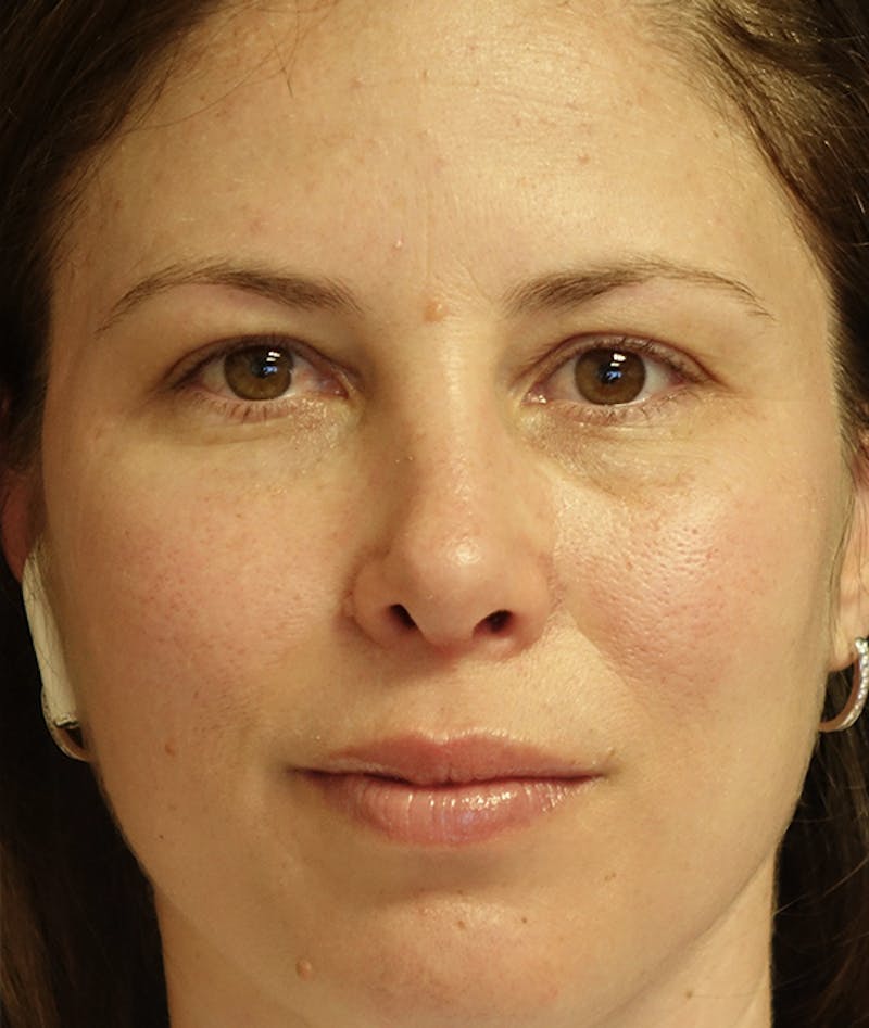 Rhinoplasty Before & After Gallery - Patient 939005 - Image 2