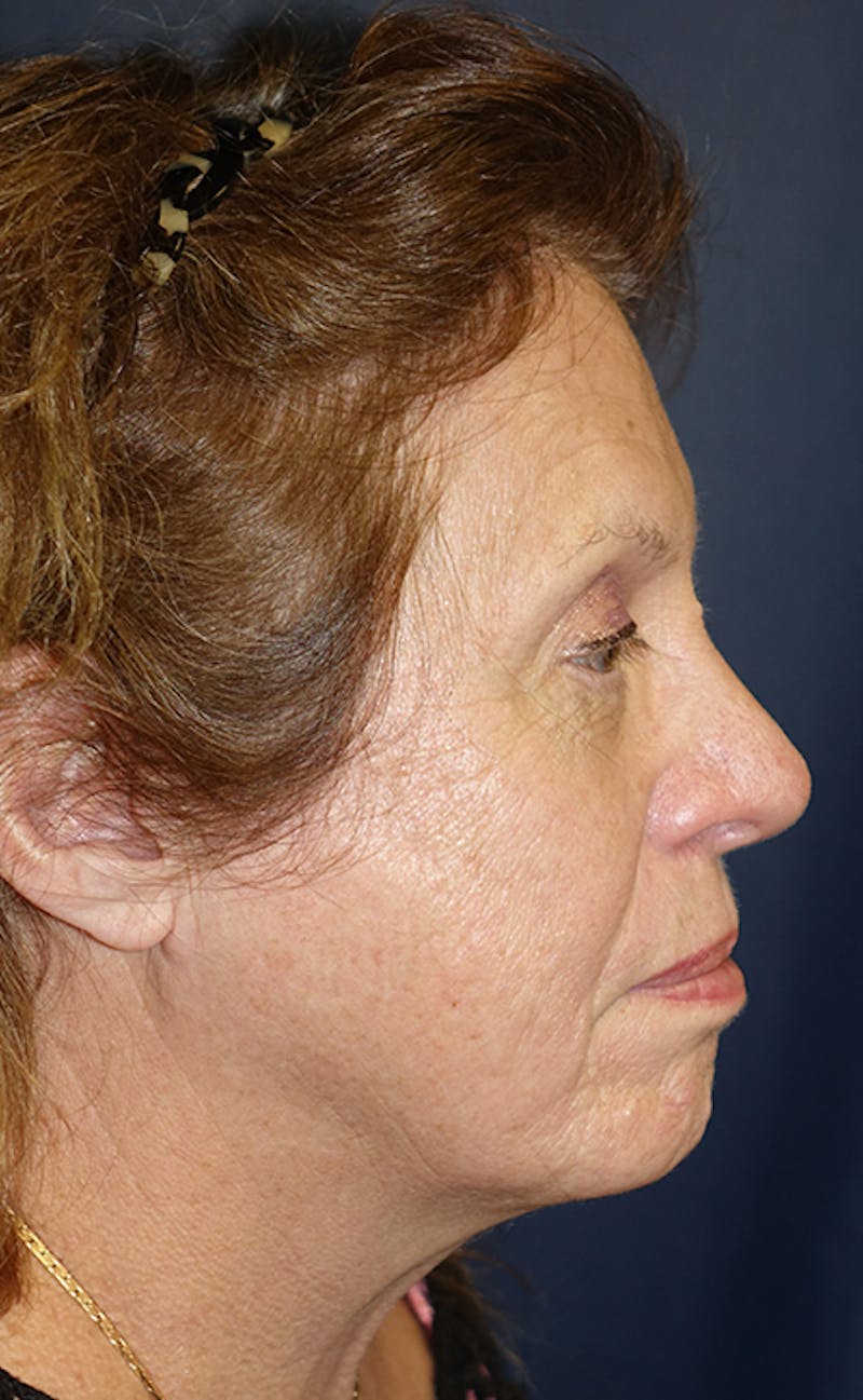 Facelift Before & After Gallery - Patient 197528 - Image 5