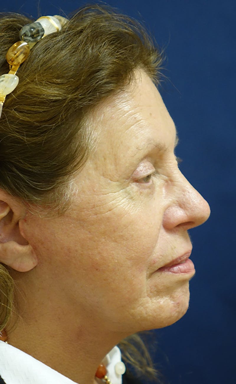 Facelift Before & After Gallery - Patient 197528 - Image 6