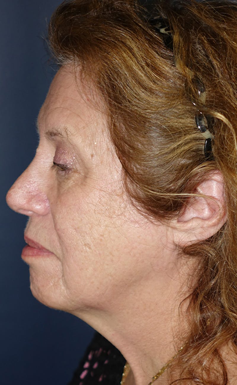Facelift Before & After Gallery - Patient 197528 - Image 3