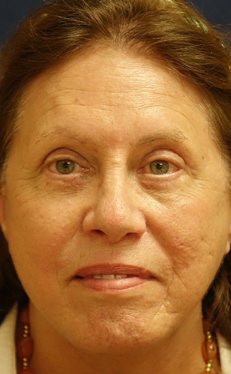 Facelift Before & After Gallery - Patient 197528 - Image 2