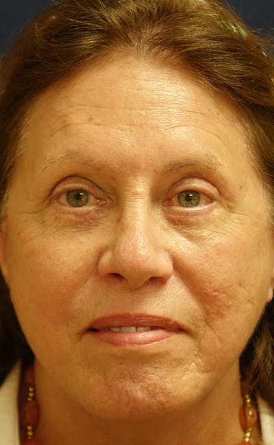 Facelift Before & After Gallery - Patient 197528 - Image 2