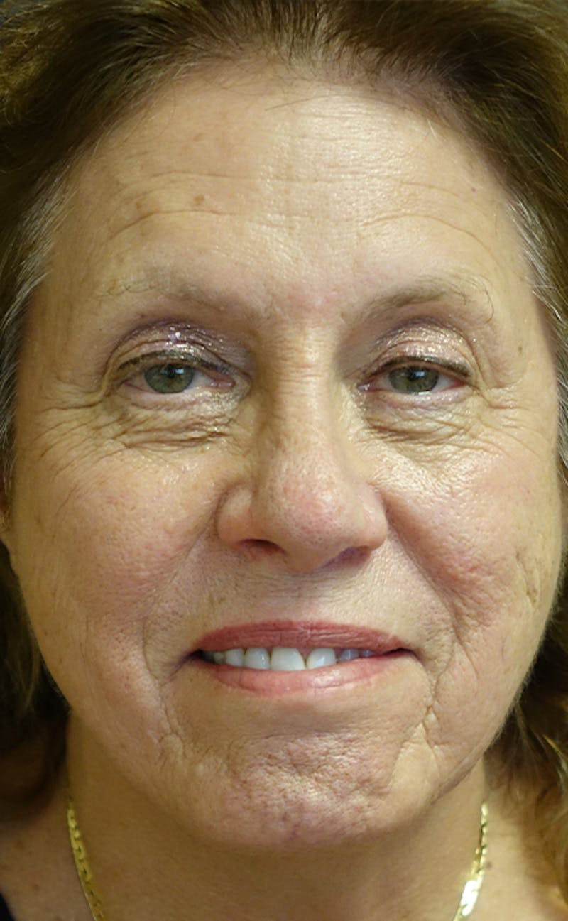 Facelift Before & After Gallery - Patient 197528 - Image 1