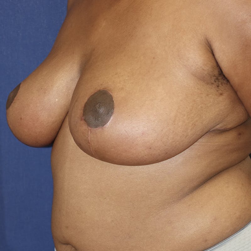 Breast Reduction Before & After Gallery - Patient 369931 - Image 10