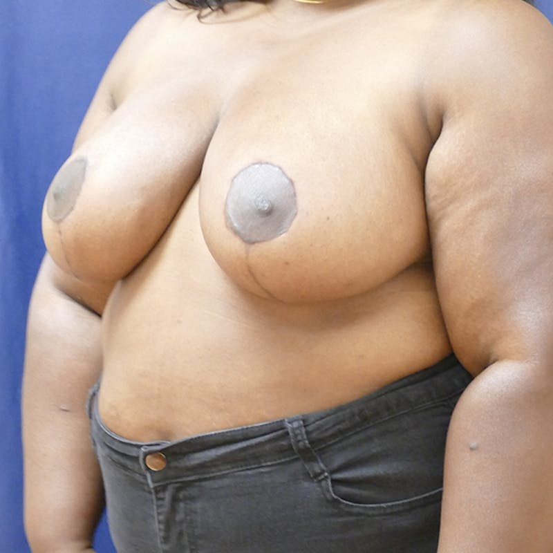 Breast Reduction Before & After Gallery - Patient 199601 - Image 4